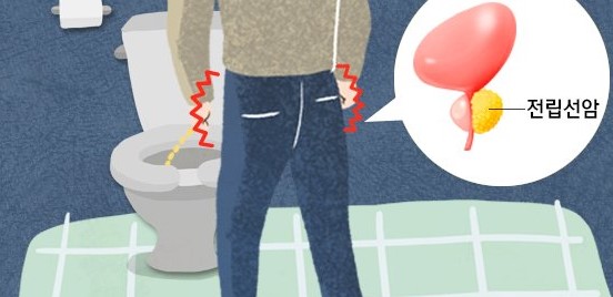 전립선암 '이것'으로 불필요한 조직검사 줄인다